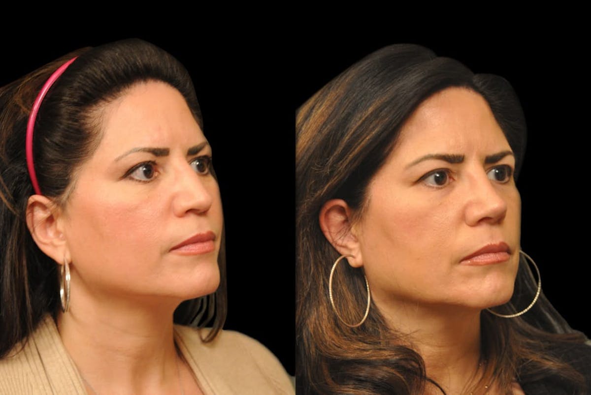 Rhinoplasty Before & After Gallery - Patient 197739 - Image 3