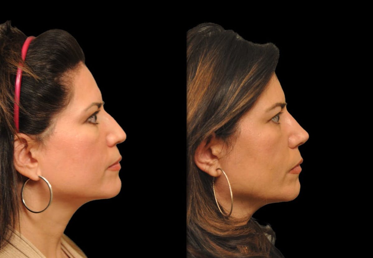 Rhinoplasty Before & After Gallery - Patient 197739 - Image 4