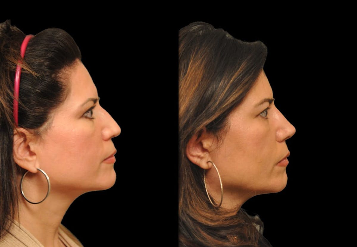 Rhinoplasty Before & After Gallery - Patient 197739 - Image 2