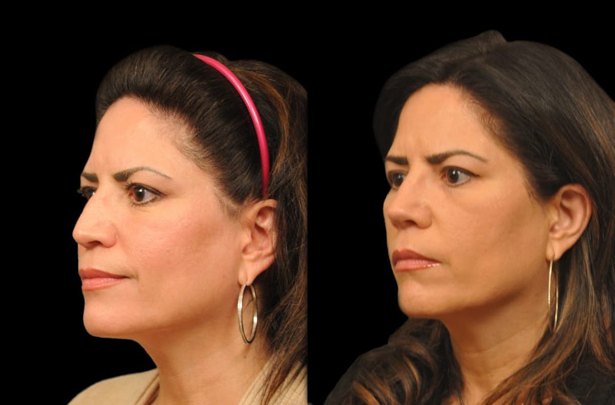 Rhinoplasty Before & After Gallery - Patient 197739 - Image 4