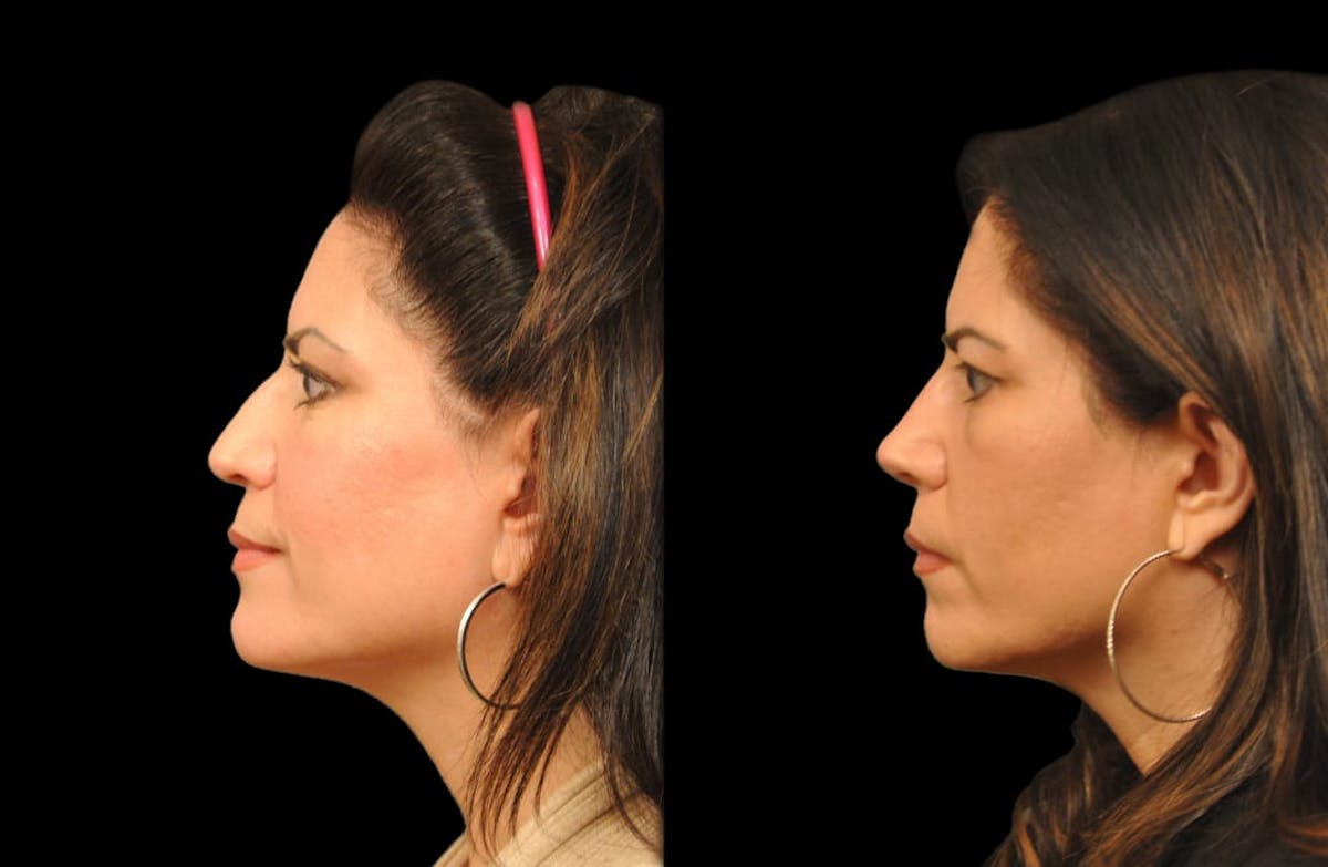 Rhinoplasty Before & After Gallery - Patient 197739 - Image 1