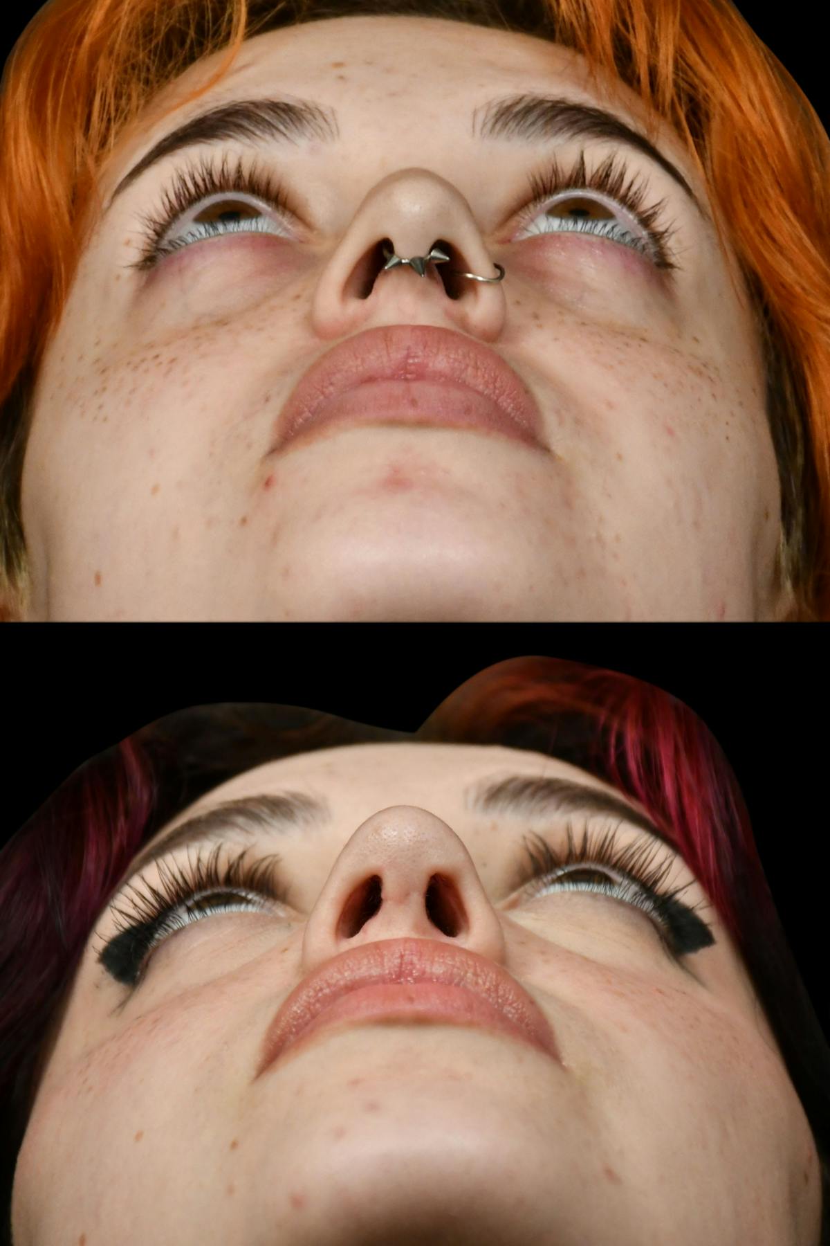 Rhinoplasty Before & After Gallery - Patient 205768 - Image 8