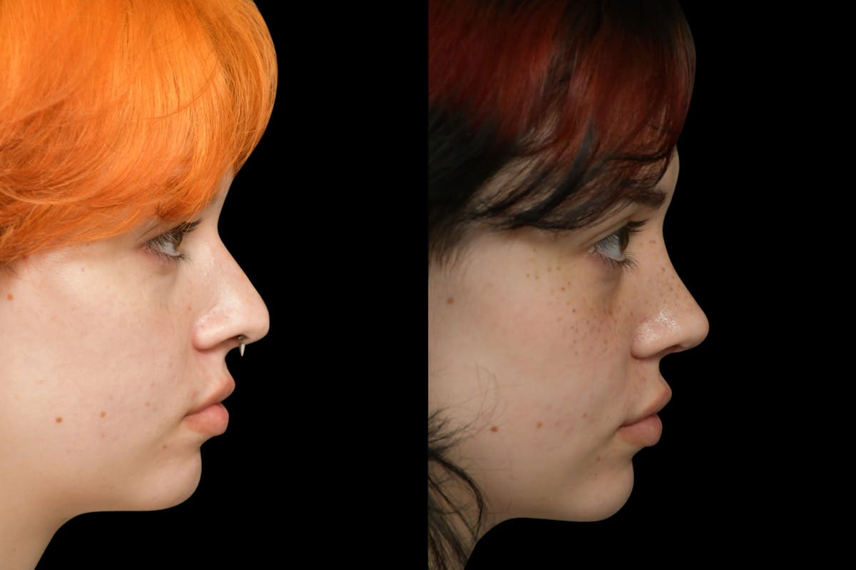 Rhinoplasty Before & After Gallery - Patient 205768 - Image 6