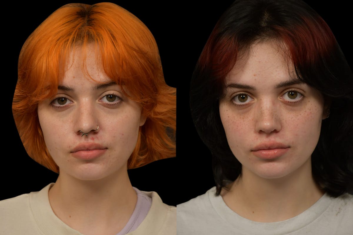 Rhinoplasty Before & After Gallery - Patient 205768 - Image 7
