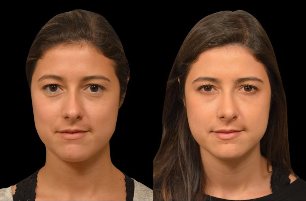 Rhinoplasty Before & After Gallery - Patient 199354 - Image 3