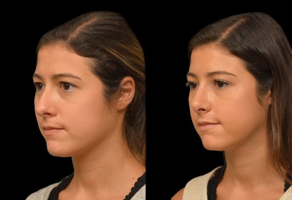 Rhinoplasty Before & After Gallery - Patient 199354 - Image 1