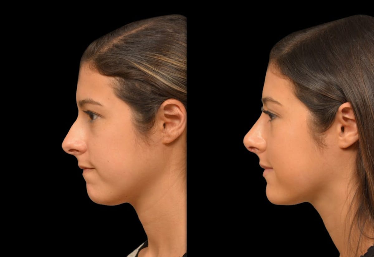 Rhinoplasty Before & After Gallery - Patient 199354 - Image 1