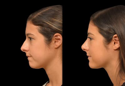 Rhinoplasty Before & After Gallery - Patient 199354 - Image 1
