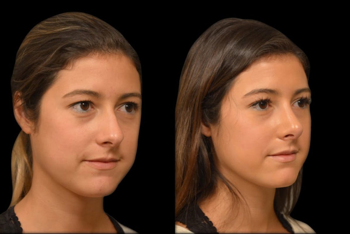 Rhinoplasty Before & After Gallery - Patient 199354 - Image 4