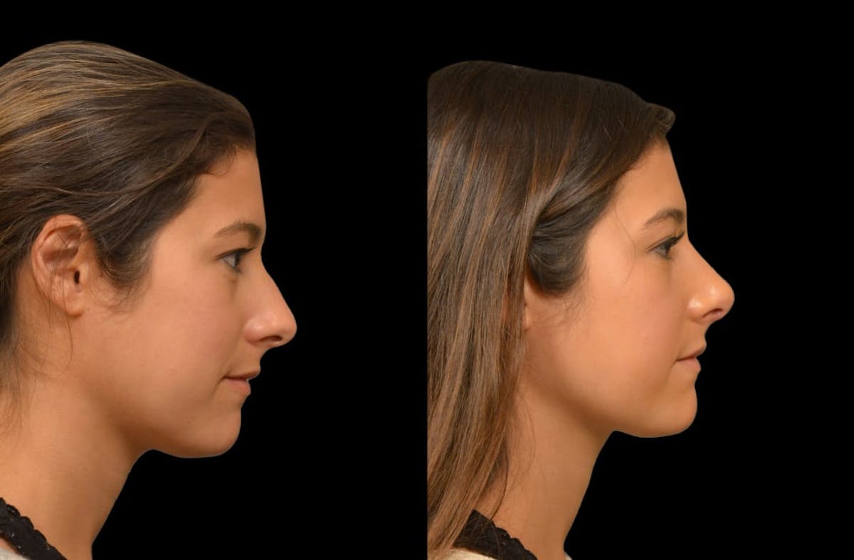 Rhinoplasty Before & After Gallery - Patient 199354 - Image 4