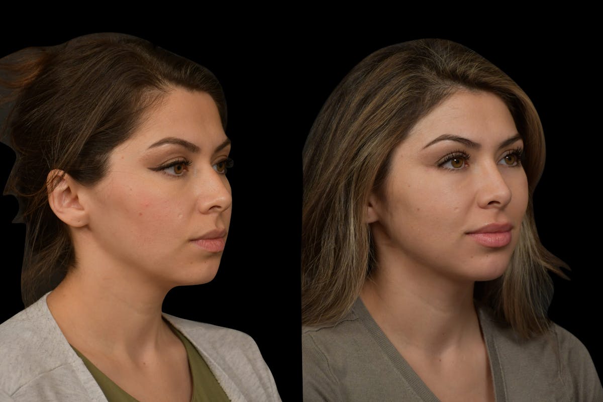 Rhinoplasty Before & After Gallery - Patient 408741 - Image 4