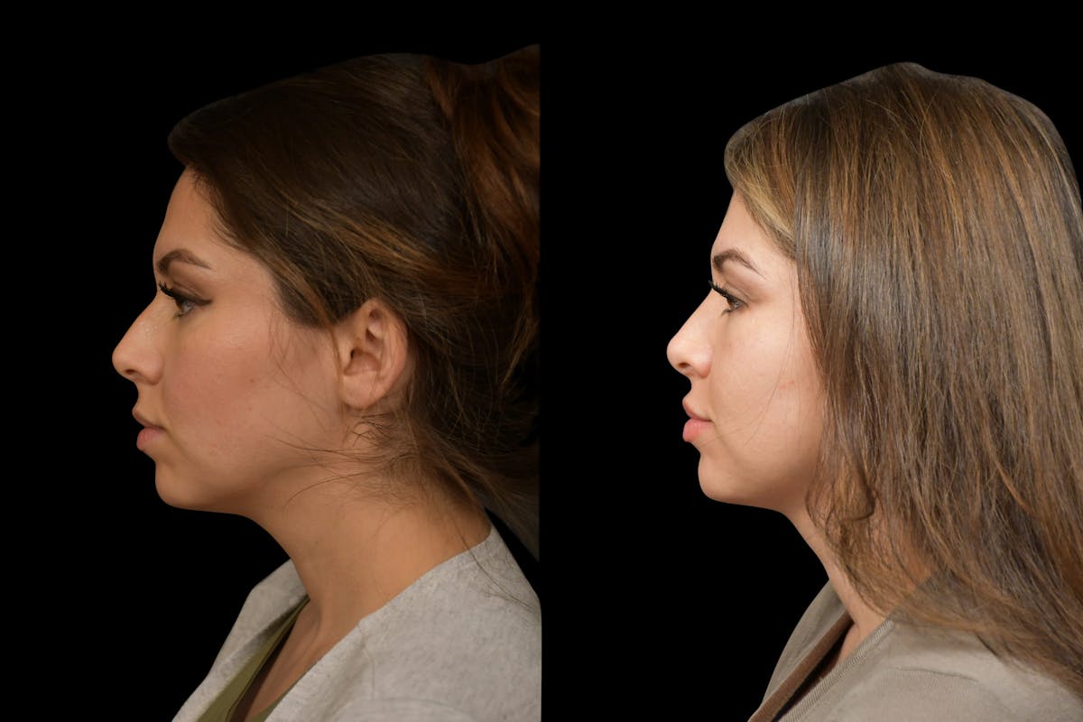 Rhinoplasty Before & After Gallery - Patient 408741 - Image 2