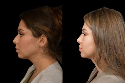 Rhinoplasty Before & After Gallery - Patient 408741 - Image 1