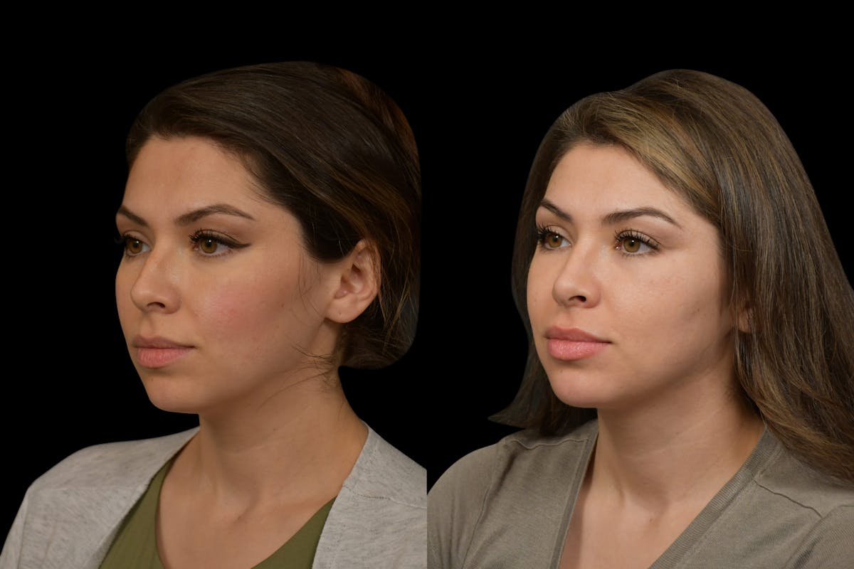 Rhinoplasty Before & After Gallery - Patient 408741 - Image 1