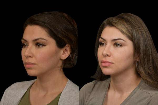 Rhinoplasty Before & After Gallery - Patient 408741 - Image 1