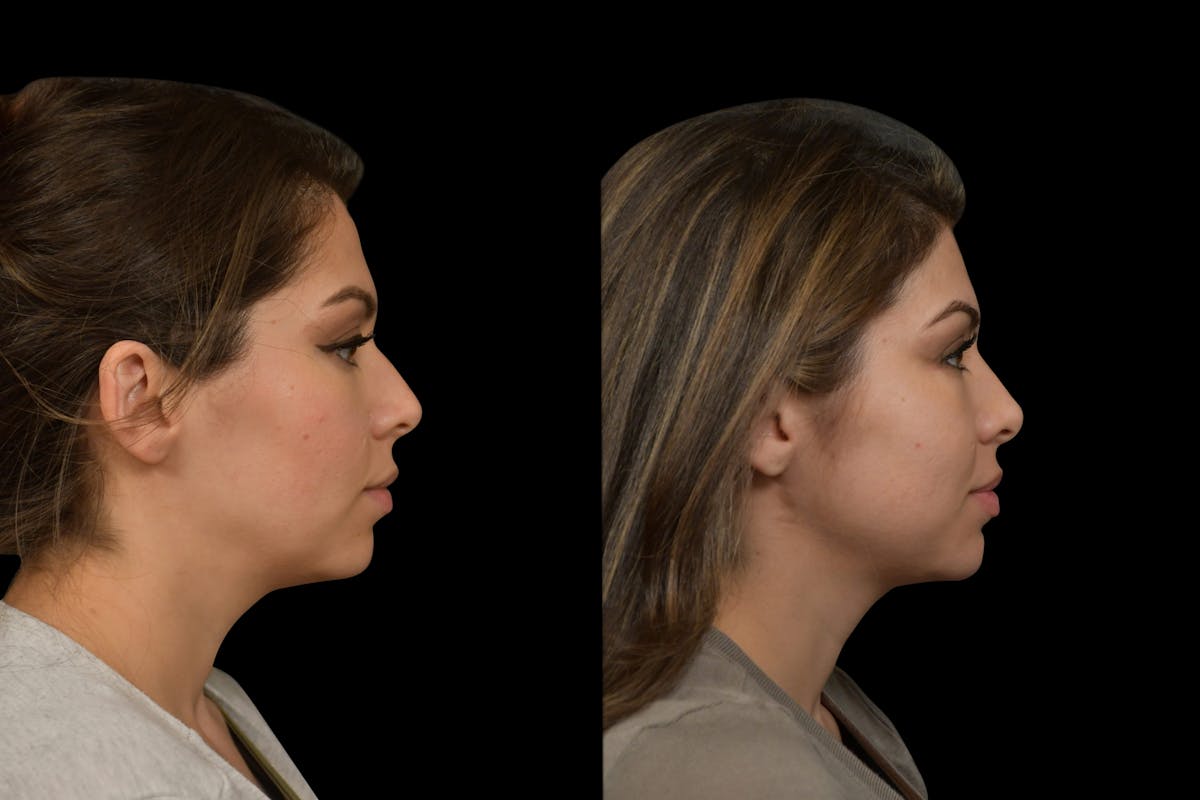 Rhinoplasty Before & After Gallery - Patient 408741 - Image 4