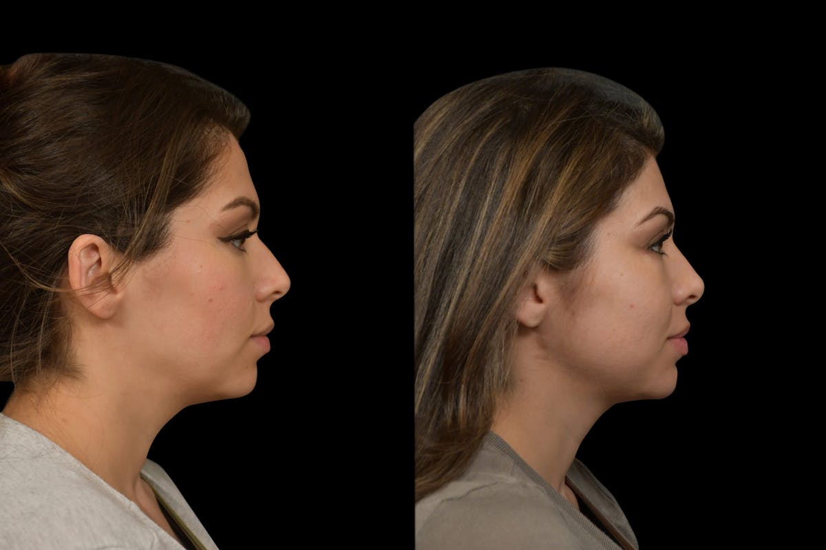 Rhinoplasty Before & After Gallery - Patient 408741 - Image 3
