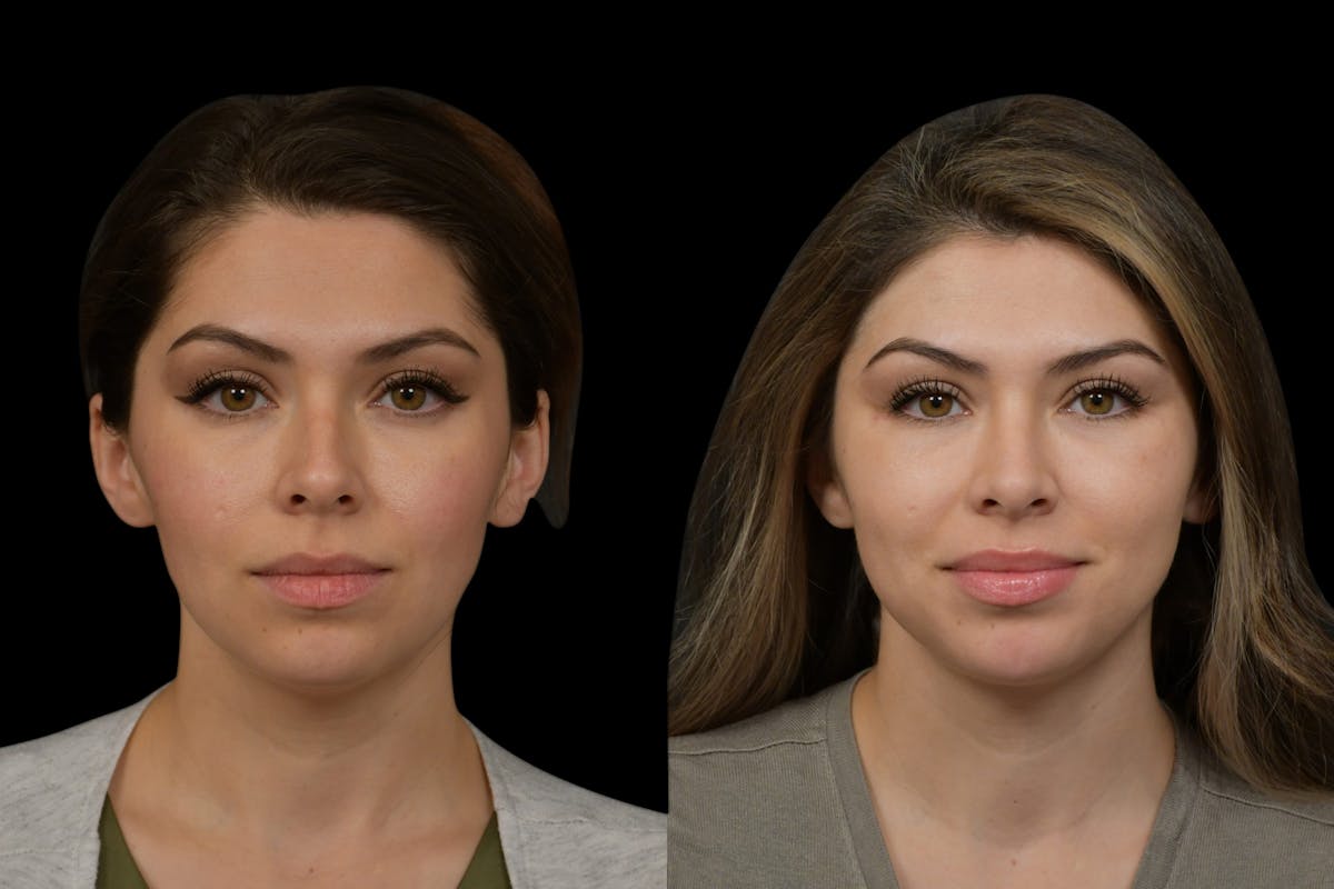 Rhinoplasty Before & After Gallery - Patient 408741 - Image 5