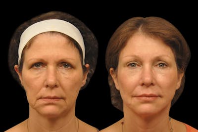 Brow Lift Before & After Gallery - Patient 120662 - Image 1
