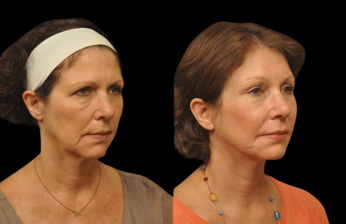 Brow Lift Before & After Gallery - Patient 120662 - Image 2