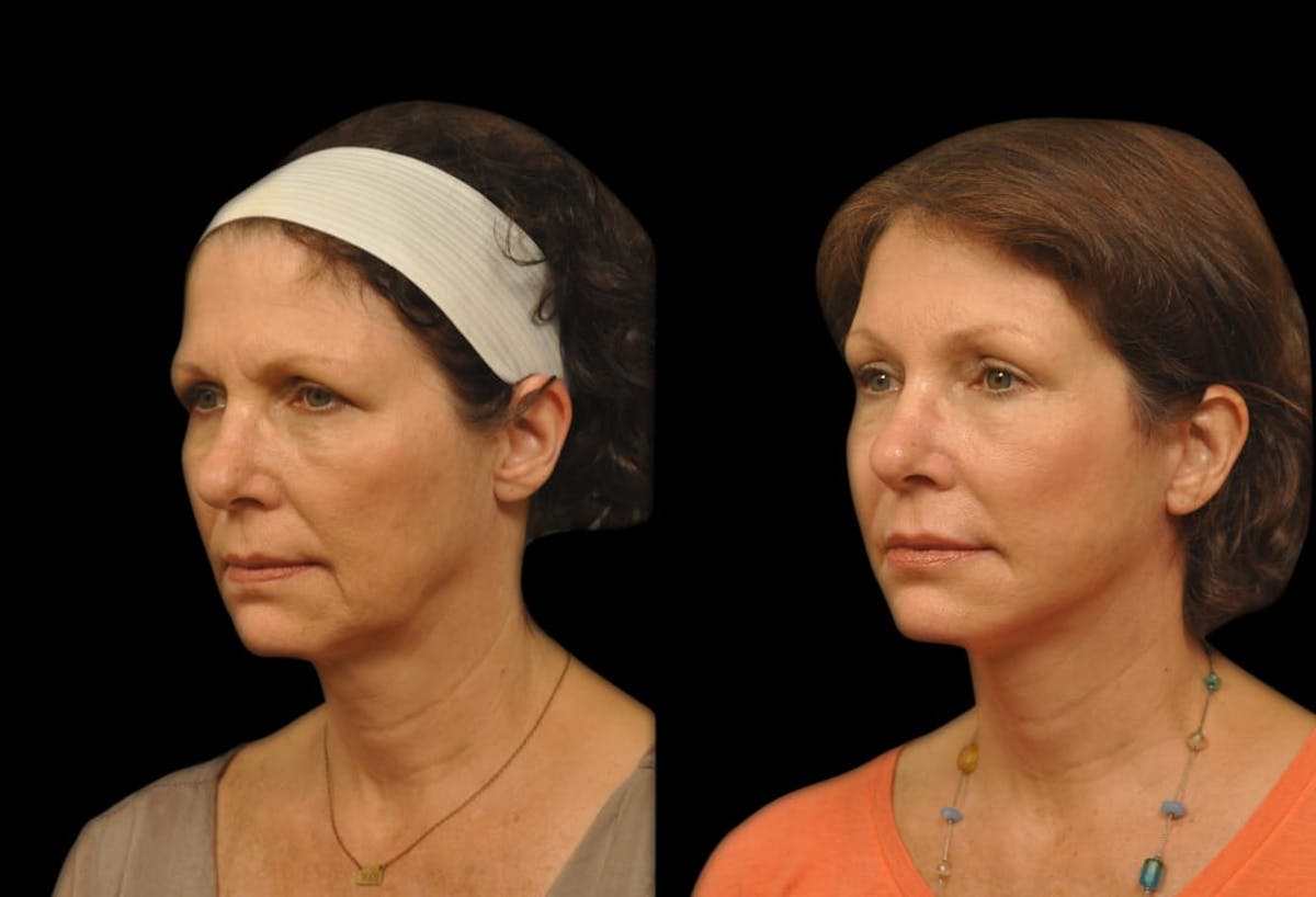 Brow Lift Before & After Gallery - Patient 120662 - Image 4