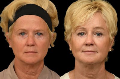 Brow Lift Before & After Gallery - Patient 314237 - Image 1