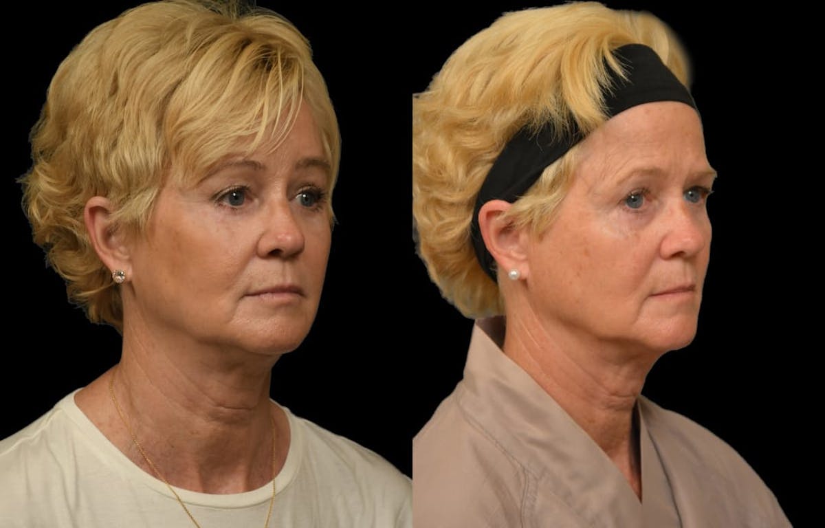 Brow Lift Before & After Gallery - Patient 314237 - Image 2