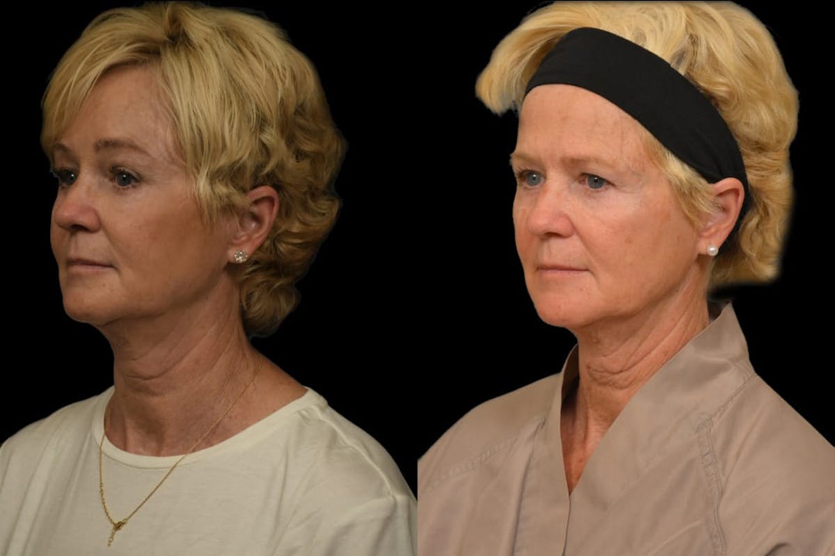 Brow Lift Before & After Gallery - Patient 314237 - Image 4
