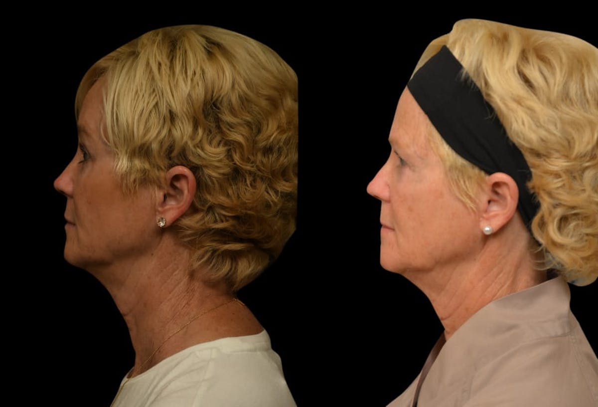Brow Lift Before & After Gallery - Patient 314237 - Image 5