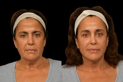 Brow Lift Before & After Gallery - Patient 180756 - Image 1