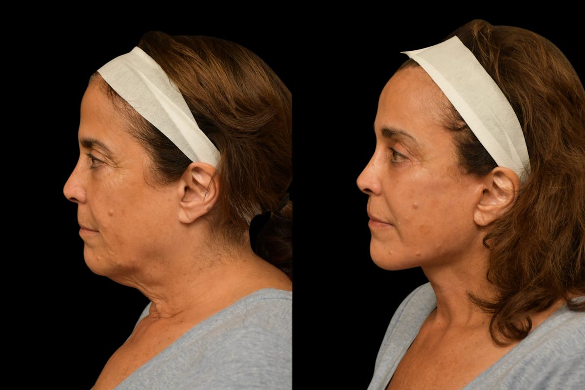 Brow Lift Before & After Gallery - Patient 180756 - Image 5