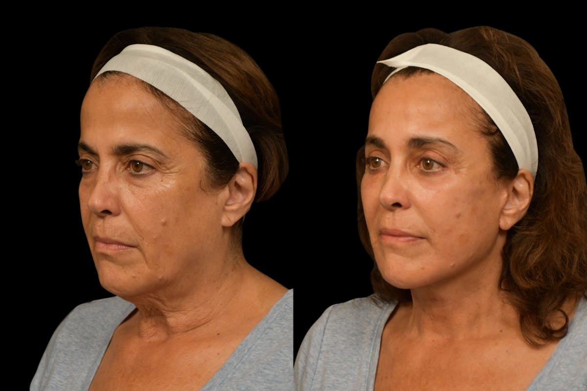 Brow Lift Before & After Gallery - Patient 180756 - Image 4