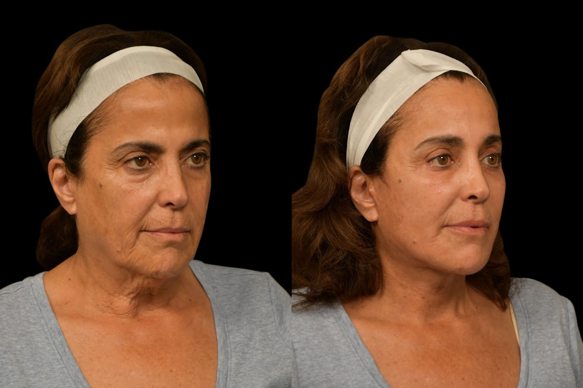 Brow Lift Before & After Gallery - Patient 180756 - Image 2