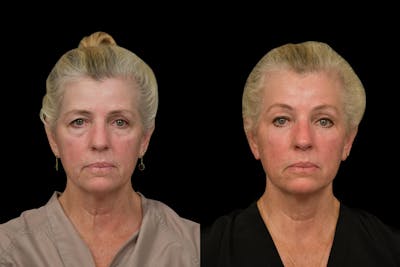 Brow Lift Before & After Gallery - Patient 298263 - Image 1