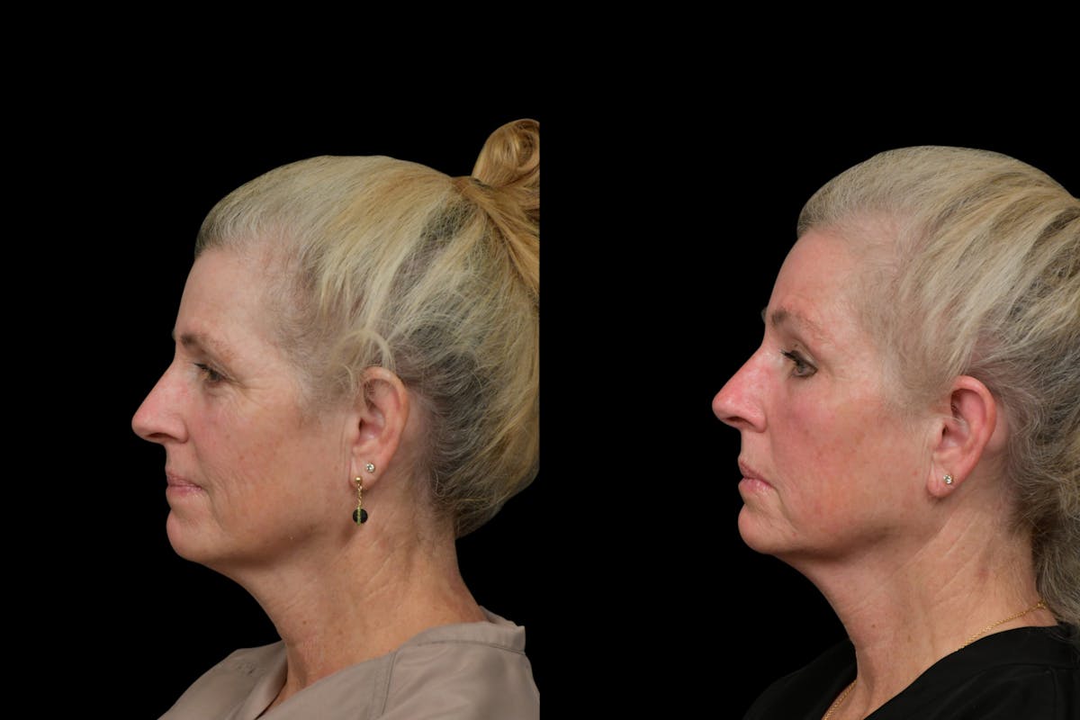 Brow Lift Before & After Gallery - Patient 298263 - Image 3