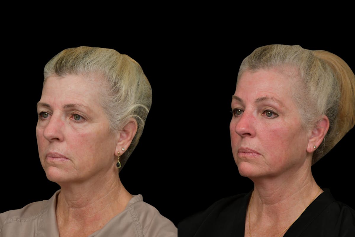 Brow Lift Before & After Gallery - Patient 298263 - Image 2