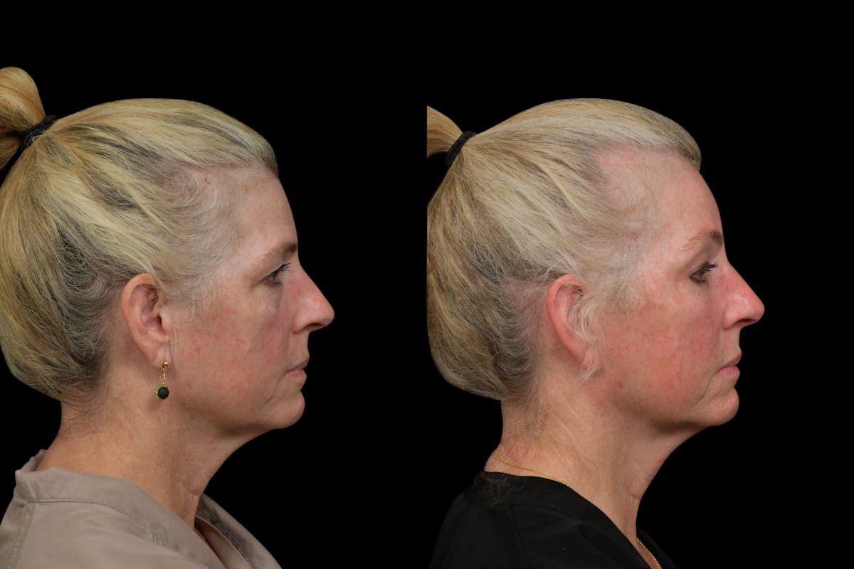 Brow Lift Before & After Gallery - Patient 298263 - Image 5