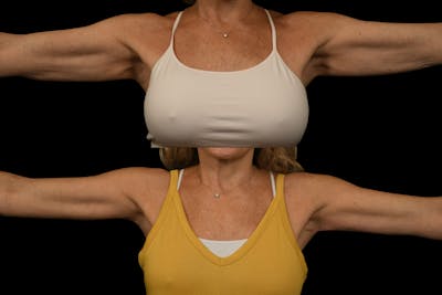 Arm Lift Before & After Gallery - Patient 446815 - Image 1