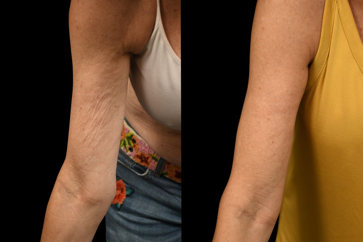 Arm Lift Before & After Gallery - Patient 446815 - Image 2