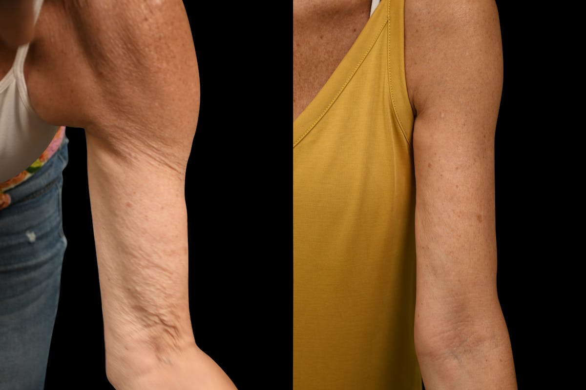 Arm Lift Before & After Gallery - Patient 446815 - Image 3
