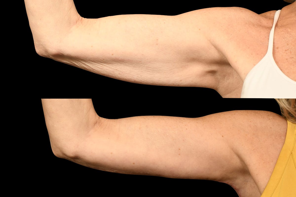 Arm Lift Before & After Gallery - Patient 446815 - Image 4