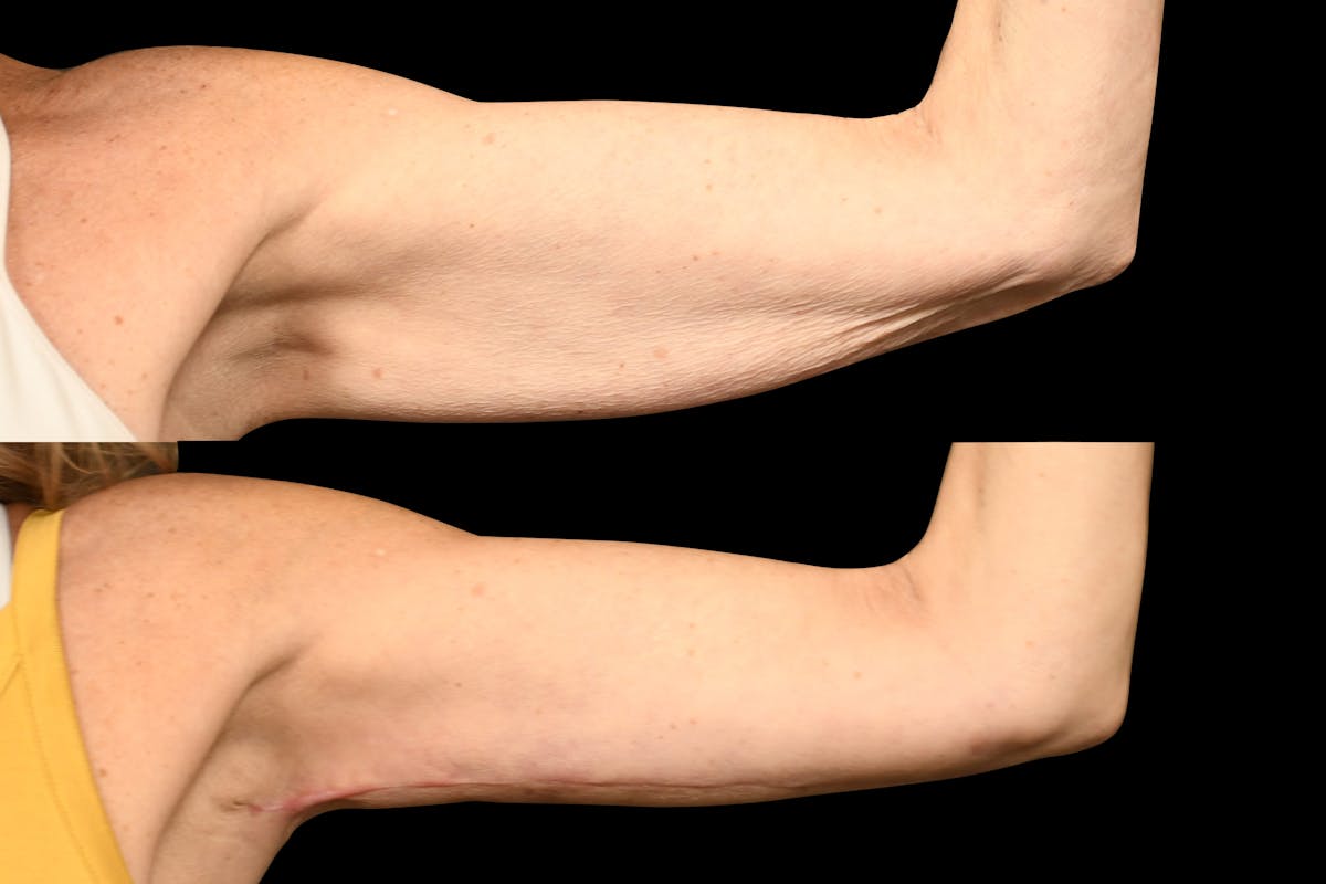 Arm Lift Before & After Gallery - Patient 446815 - Image 5