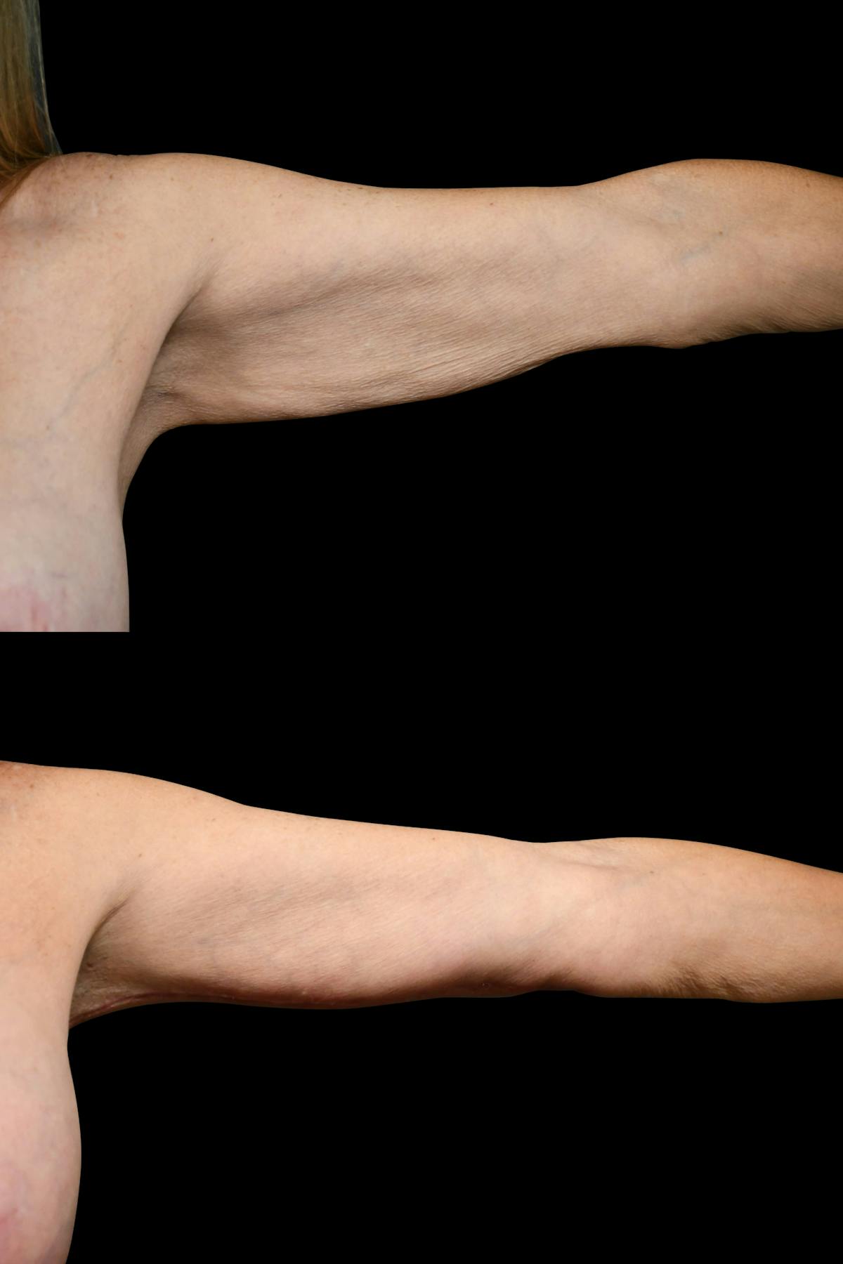 Arm Lift Before & After Gallery - Patient 258048 - Image 1