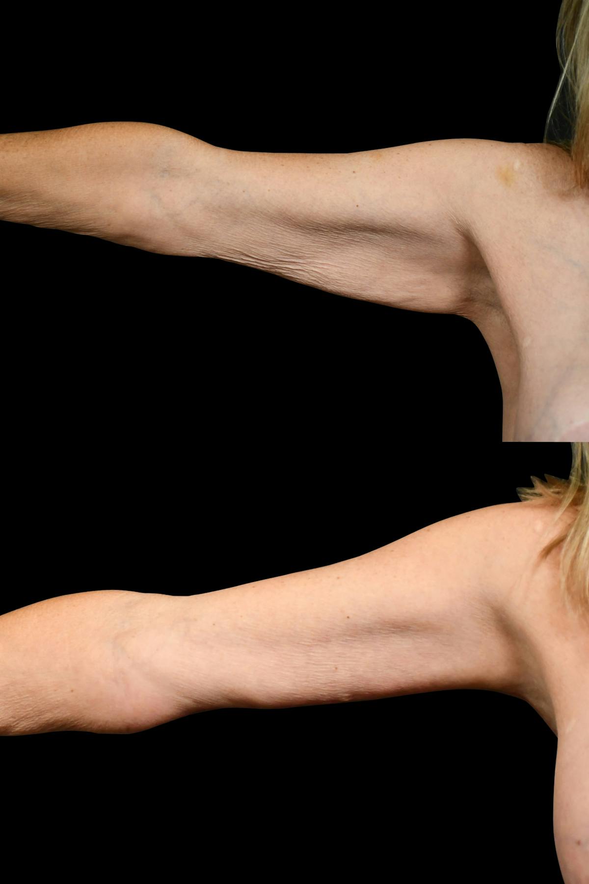 Arm Lift Before & After Gallery - Patient 258048 - Image 2