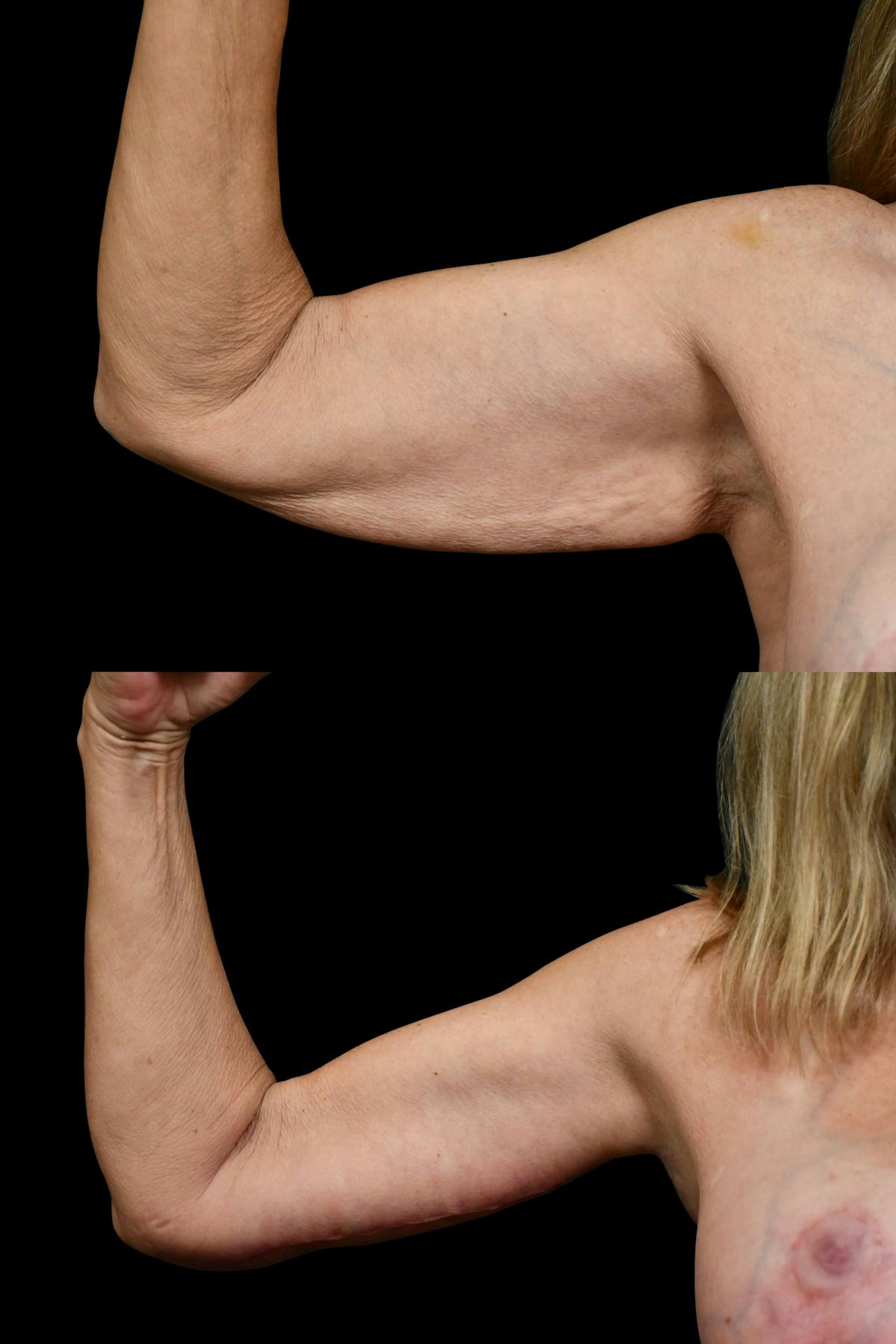 Arm Lift Before & After Gallery - Patient 258048 - Image 3