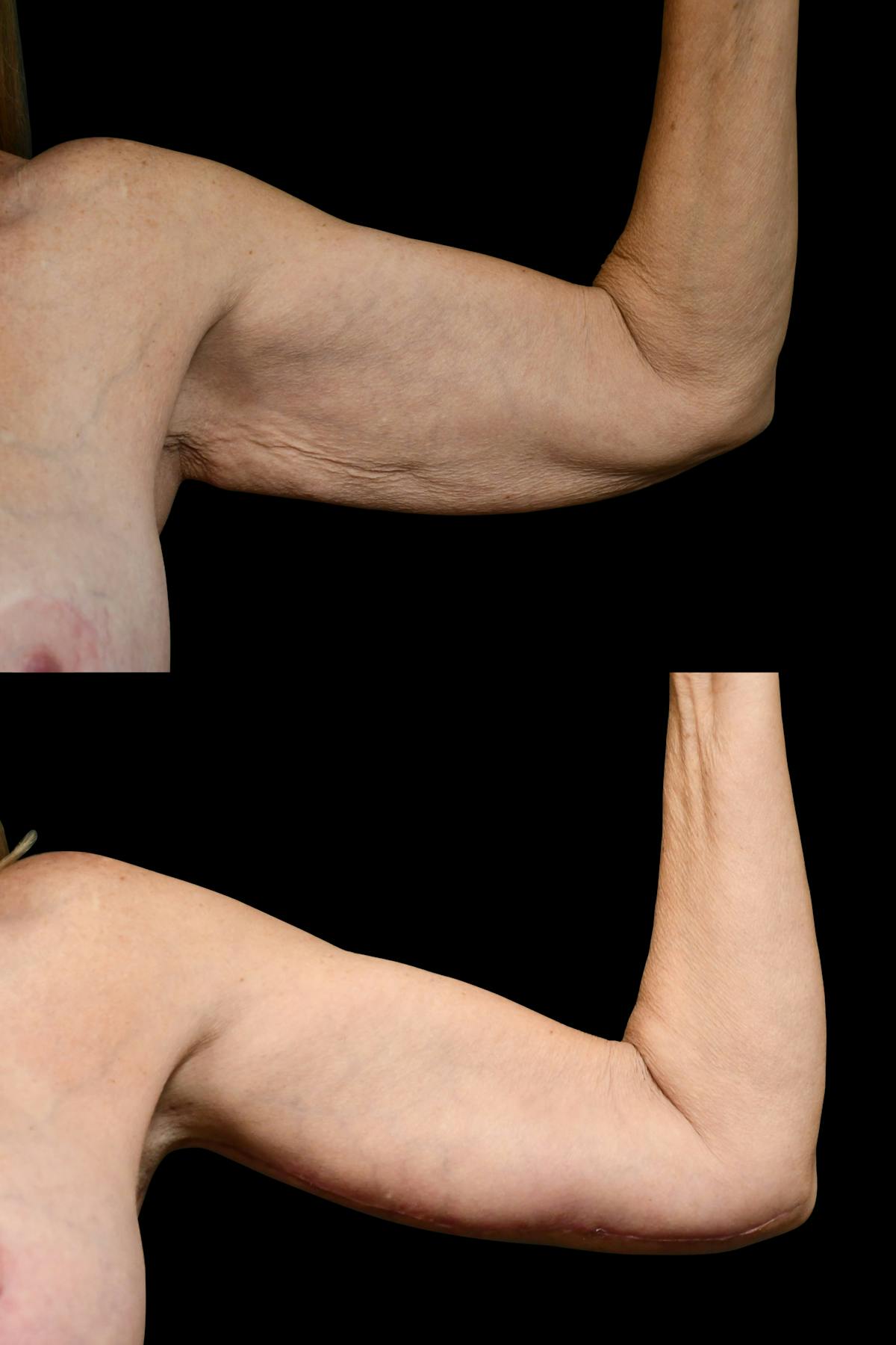 Arm Lift Before & After Gallery - Patient 258048 - Image 4