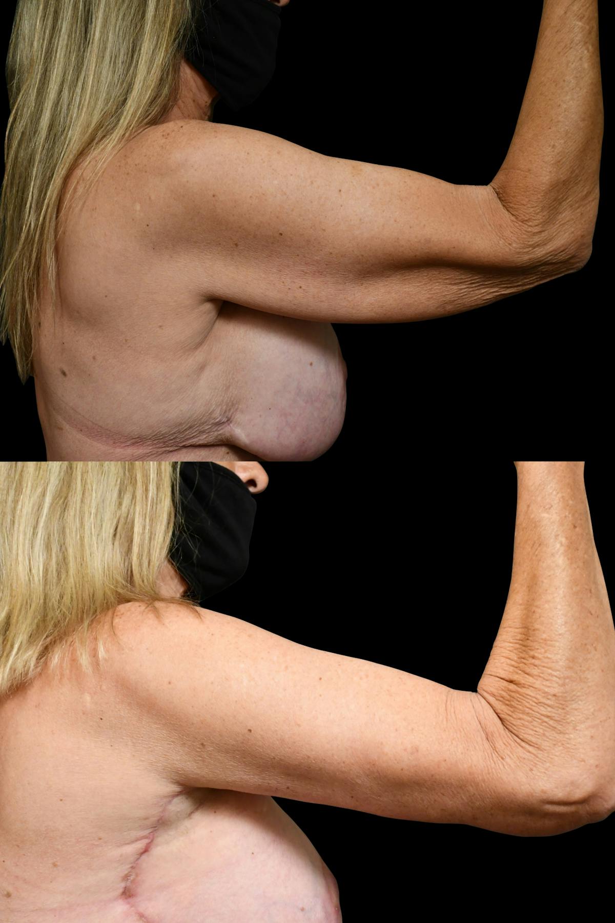 Arm Lift Before & After Gallery - Patient 258048 - Image 5