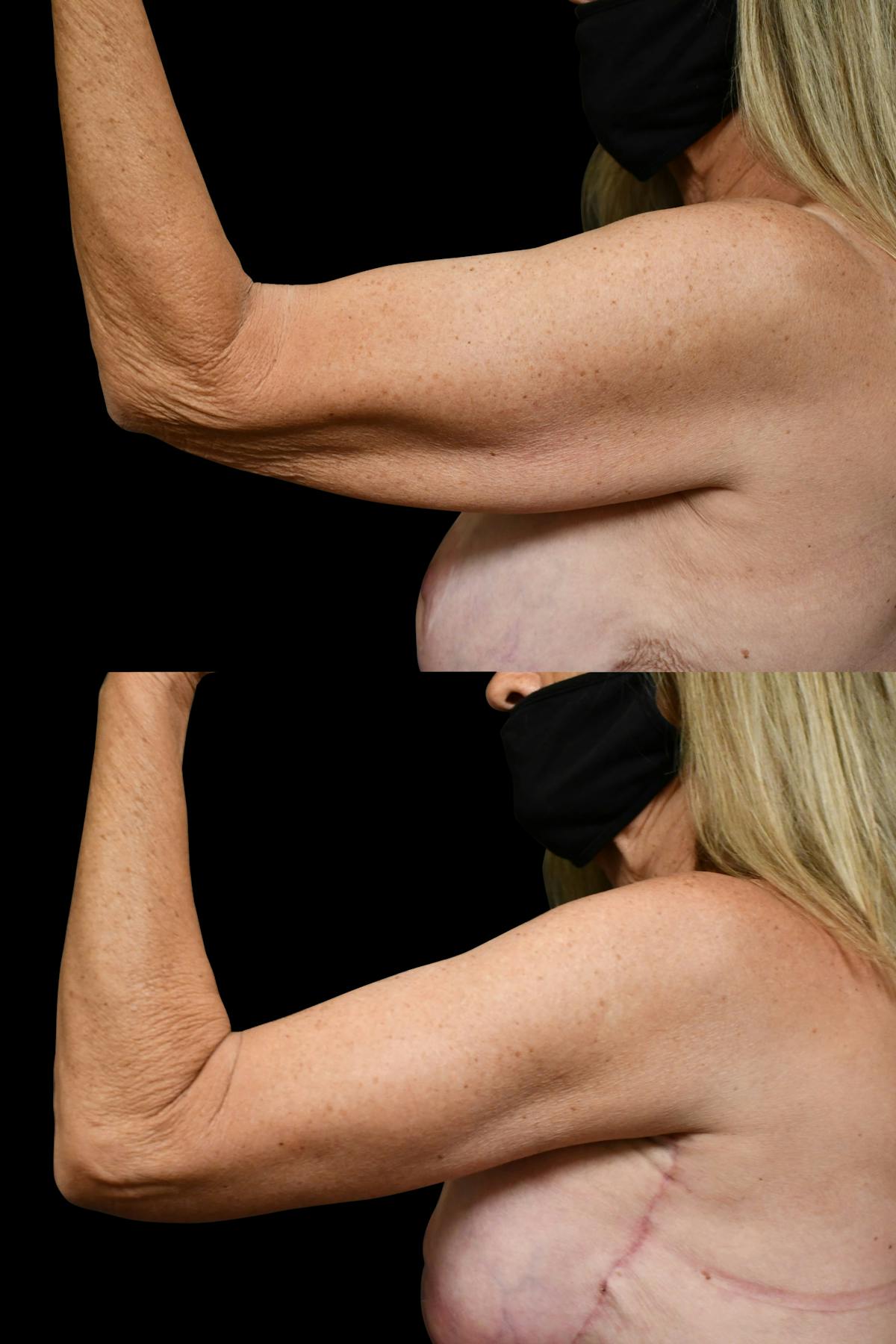 Arm Lift Before & After Gallery - Patient 258048 - Image 6