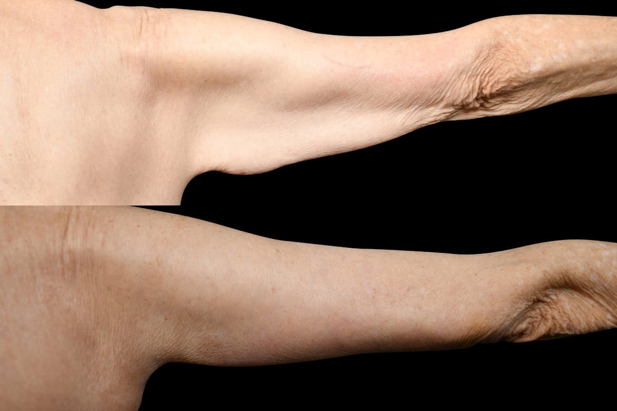 Arm Lift Before & After Gallery - Patient 119053 - Image 3