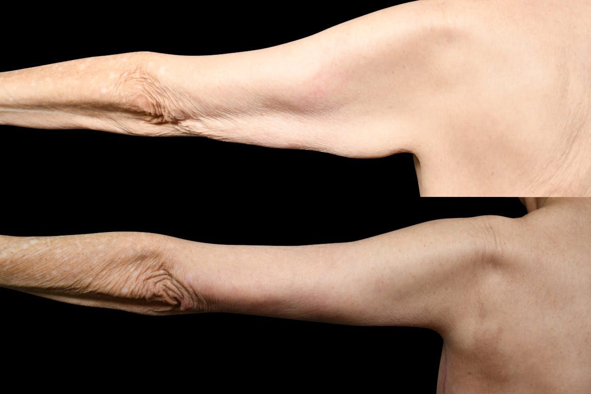 Arm Lift Before & After Gallery - Patient 119053 - Image 4